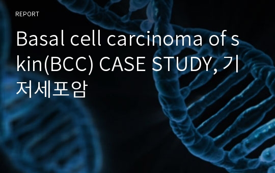 Basal cell carcinoma of skin(BCC) CASE STUDY, 기저세포암